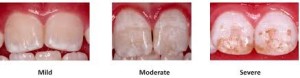 Fluorosis kids 3 stages