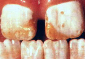 Colquhoun Dental Fluorosis 2