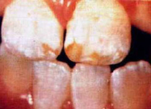 Colquhoun Dental Fluorosis